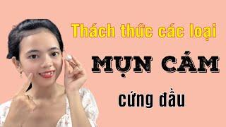 CÁCH TRỊ MỤN CÁM TRÊN MŨI VÀ DA MẶT NGAY TẠI NHÀ ( da láng mịn thật nhanh)