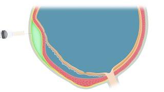 Animated Illustration of the Suprachoroidal Viscopexy Procedure