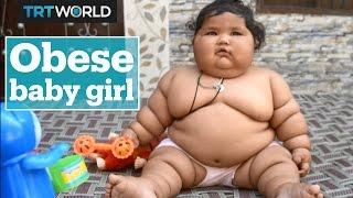 Obese baby leaves doctors confused