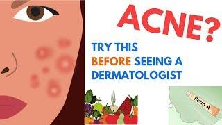 ACNE Treatments | Explained by Dermatologist