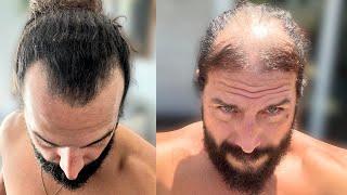 BALDING MAN Documents SHOCKING! Hair TRANSFORMATION *Wholesome*
