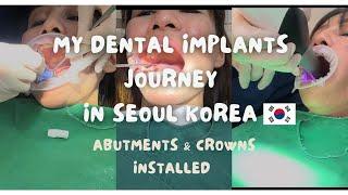 DENTAL SURGERY PART 2 in SOUTH KOREA | THE FINALE | ABUTMENTS AND CROWNS