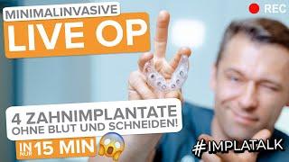 4 Implantate LIVE-OP ohne Schneiden und ohne Blut! Minimalinvasive Implantat-OP