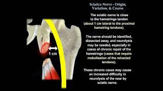 Sciatic Nerve Origin Variation & Course   Everything You Need To Know   Dr  Nabil Ebraheim