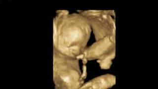 3 d Scan, Dublin Ireland - www.Ultrasound.ie