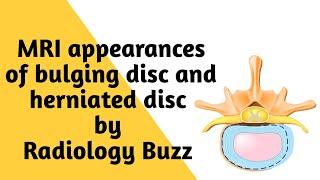 Understanding the Difference Between a Bulging Disc and a Herniated Disc