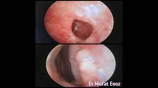 Nasal Septum Perforation Surgery - Before and 1 Month After  -Nazal Septum Perforasyonu Ameliyatı