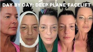 Day by Day Deep Plane Facelift Recovery: Three Months Post-Op