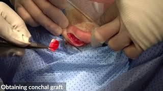 Obtaining Conchal Graft in 2 minutes-19/994:Rhinoplasty Bizrah- London/Dubai- Dr. Bashar Bizrah