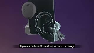 ¿Cómo Funciona el Sistema Cochlear™ Osia®? | Cochlear Americas