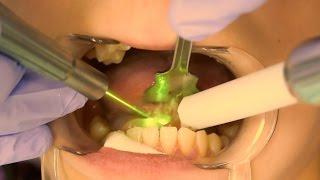 Tongue-Tie Laser Surgery by Dr. Jason Tubo