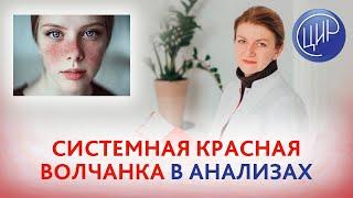 Системная красная волчанка. Антитела к СКВ в анализах. Дементьева С.Н.