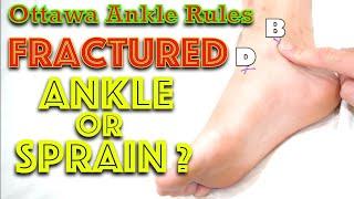 How to Diagnose an Ankle Fracture - Ottawa ankle rules - Dr Gill