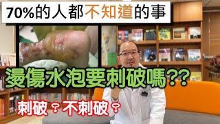 燙傷產生的水泡到底要不要用掉？不用破傷口比較快好？