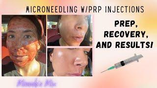 Microneedle w/PRP Eye Injections! Prep, Recovery & Results!