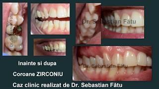 Coroane dentare din zirconiu.