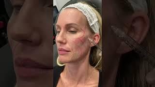 The Sculptra Collagen Stimulater Results at Dr. Medispa