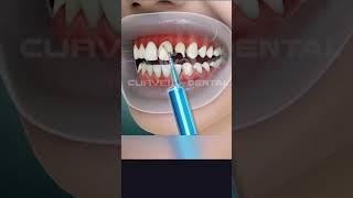 AWESOME Installation of Veneers | Cosmetic Dentistry