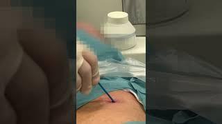 Ultrasound guided pericardiocentesis