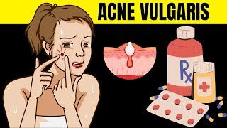 Acne Vulgaris - Causes, Risk Factors, Signs And Symptoms, And Various Treatment Options