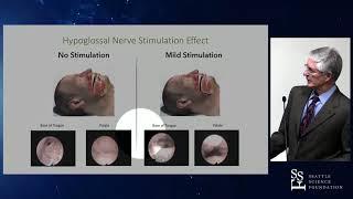 Hypoglossal Nerve Stimulation For Select Sleep Apnea Patients - John T. Parker, MD