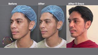 The Next gen RF w/ Microneedling for treatment of acne scars and skin laxity, combined w/ UltraCol