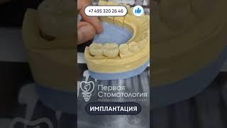 Имплантация зубов пациенту. Интересный случай. Часть 2