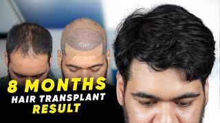 Hair Transplant in Russia | Best Results & Cost of Hair Transplant in Russia