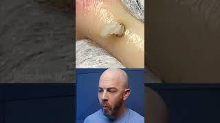 Satisfying Pimple Pop Reaction Compilation! #satisfying #pimplepopper