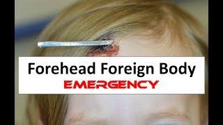 Removing a Foreign Body from a Child's Forehead