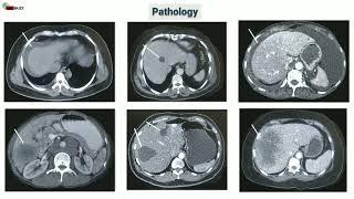 Triple Phase CT Scan (Multiphase Abdominal CT) || Radiology Buzz
