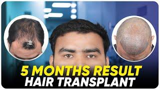 Hair Transplant in Bhopal | Best Results & Cost of Hair Transplant in Bhopal