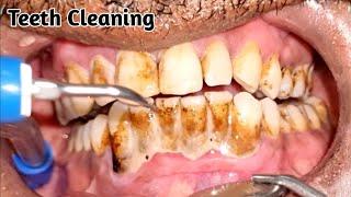 Teeth Cleaning By Doctor | Scaling of Teeth | Heavy Tartar Removal