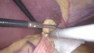 Laparoscopic Sleeve gastrectomy
