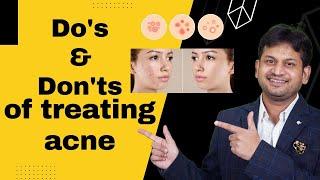 How To Get Rid Of Acne: Dos And Don'ts | #acne #acne_treatment