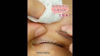 眼周最常見的粟粒腫(脂肪粒)。#Blackheads#acne#粉刺#Milia#にきび