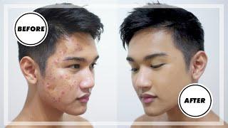 How to Cover Men's ACNE & SCARS // Men's Makeup Tutorial