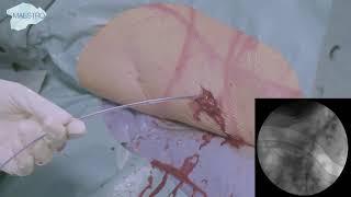 Supine - PCNL for a renal stone in the left renal pelvis using dual action lithotripsy