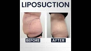 Liposuction Surgery Before After