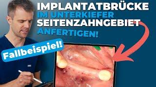 Implantatbrücke im Unterkiefer Seitenzahngebiet | Fallbeispiel