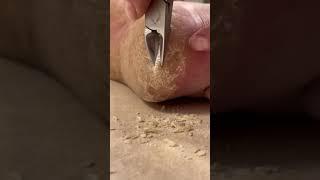 Skin picking PART 5 plus new grater - foot callus w/hyperkeratosis Keratoderma EPPK  - May 9, 2023