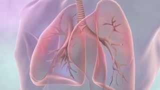 Treatments for lung cancer | Cancer Research UK