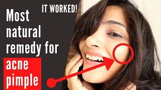 Acne Pimple treatment [Natural remedy] at home | mouth saliva benefits | saliva for acne