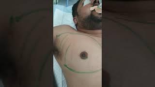 Grade 3A Gynecomastia Surgery