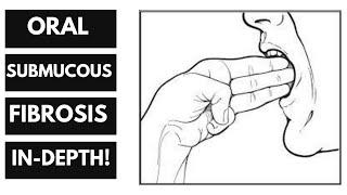 Oral Submucous Fibrosis - Everything you need to know, From Introduction to Management.