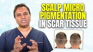 Scalp Micro Pigmentation to Camouflage Scars | The Hair Loss Show