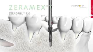 Zirconium Implant ZERAMEX® T Handling