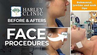 Plastic Surgery Face Procedure Before & Afters - Face, Neck & Eyebrow Lifts | Harley Clinic (Vol 2)