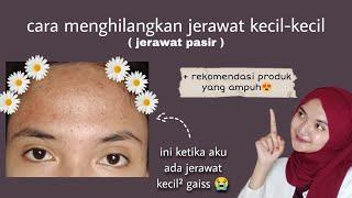 cara menghilangkan jerawat kecil-kecil ( jerawat pasir ) 