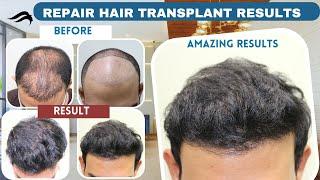 Hair Transplant In Chennai | Best Clinic Cost Surgeon & Results Of Hair Transplant Of Chennai